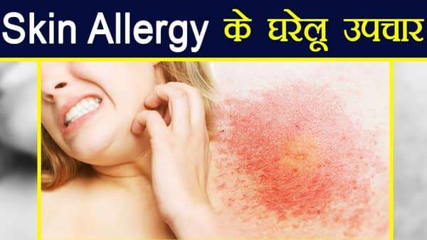 एलर्जी होने के कारण और उससे सही करने के घरेलु उपाय