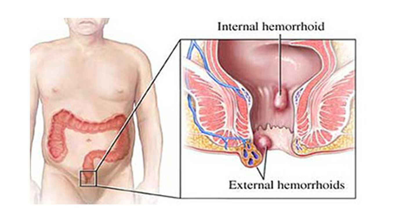 बवासीर (पाइल्स) के लक्षण, कारण, घरेलू इलाज और परहेज : Home Remedies for Piles (Hemorrhoids)