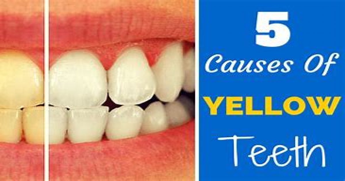 घरेलु टिप्स – दांतों के पीलेपन को जड़ से करे खत्म