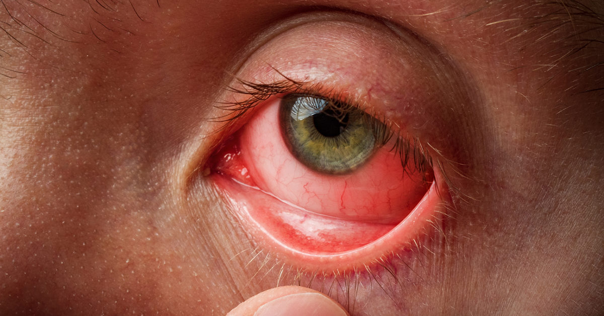 आँख की चोटों के 7 सामान्य प्रकार और उनके उपचार